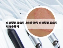 点滴型银屑病可以吃香菇吗 点滴型银屑病可以吃香蕉吗