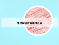 牛皮癣治愈后黑斑几年