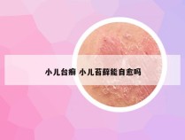 小儿台癣 小儿苔藓能自愈吗