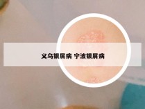 义乌银屑病 宁波银屑病
