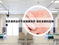 张氏祖传治疗牛皮癣黑膏药 张氏皮肤科在哪里