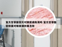复方甘草酸苷片对银屑病有用吗 复方甘草酸苷胶囊对银屑病效果怎样