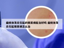 扁桃体发炎引起的银屑病能治好吗 扁桃体发炎引起银屑病怎么治