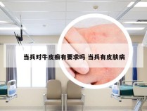当兵对牛皮癣有要求吗 当兵有皮肤病