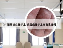 银屑病在肚子上 银屑病肚子上多容易好吗