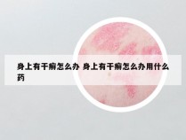 身上有干癣怎么办 身上有干癣怎么办用什么药