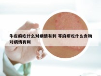 牛皮癣吃什么对病情有利 荨麻疹吃什么食物对病情有利