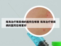 珠海治疗银屑病的医院在哪里 珠海治疗银屑病的医院在哪里好
