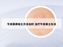 牛皮癣用啥土方法治好 治疗牛皮癣土办法