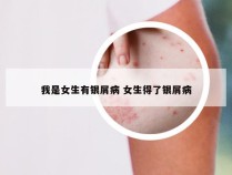 我是女生有银屑病 女生得了银屑病