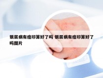 银屑病有痘印算好了吗 银屑病有痘印算好了吗图片