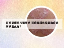 百癣夏塔热片银屑病 百癣夏塔热胶囊治疗银屑病怎么样?