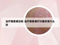 治疗银屑病注射 治疗银屑病打针最好用什么药