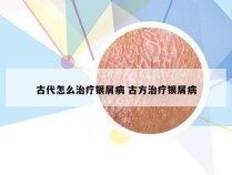 古代怎么治疗银屑病 古方治疗银屑病