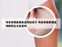 母亲有银屑病会遗传给孩子 母亲有银屑病遗传概率比父亲高吗