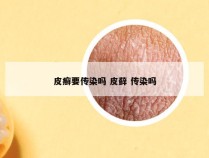 皮癣要传染吗 皮藓 传染吗