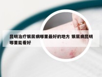 昆明治疗银屑病哪里最好的地方 银屑病昆明哪里能看好