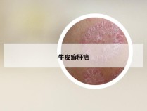 牛皮癣肝癌