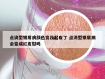 点滴型银屑病颜色变浅起皮了 点滴型银屑病会变成红皮型吗