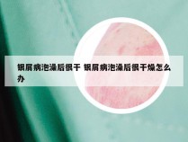 银屑病泡澡后很干 银屑病泡澡后很干燥怎么办