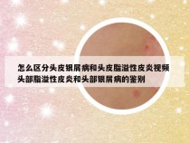 怎么区分头皮银屑病和头皮脂溢性皮炎视频 头部脂溢性皮炎和头部银屑病的鉴别