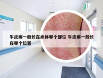 牛皮癣一般长在身体哪个部位 牛皮癣一般长在哪个位置