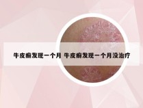 牛皮癣发现一个月 牛皮癣发现一个月没治疗