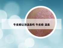 牛皮癣让泡温泉吗 牛皮癣 温泉