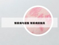 银屑病与尿酸 银屑病尿酸高