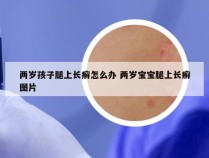 两岁孩子腿上长癣怎么办 两岁宝宝腿上长癣图片