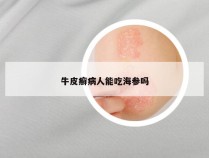 牛皮癣病人能吃海参吗