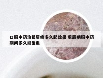 口服中药治银屑病多久起效果 银屑病服中药期间多久能消退