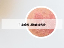 牛皮癣可以擦硅油乳膏