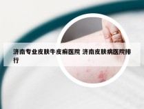 济南专业皮肤牛皮癣医院 济南皮肤病医院排行