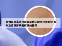 郑州在哪家医院治银屑病正规医院哪家好 郑州治疗银屑病最权威的医院