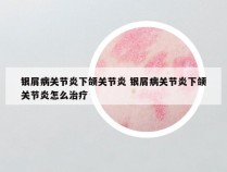 银屑病关节炎下颌关节炎 银屑病关节炎下颌关节炎怎么治疗