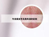 牛皮癣关节炎类风湿的区别