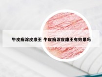 牛皮癣涂皮康王 牛皮癣涂皮康王有效果吗