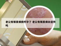 老公有银屑病我怀孕了 老公有银屑病会遗传吗