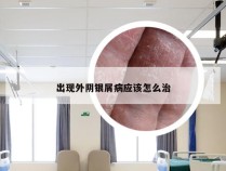 出现外阴银屑病应该怎么治