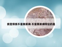 我觉得我不是银屑病 不是银屑病特征的是