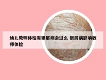 幼儿教师体检有银屑病会过么 银屑病影响教师体检