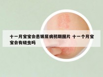 十一月宝宝会患银屑病初期图片 十一个月宝宝会有蛲虫吗