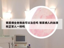 银屑病全身换血可以治愈吗 银屑病人的血液和正常人一样吗