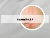 牛皮癣有没有土方