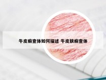 牛皮癣查体如何描述 牛皮肤癣查体
