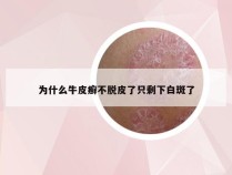 为什么牛皮癣不脱皮了只剩下白斑了