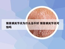 银屑病关节炎为什么治不好 银屑病关节炎可怕吗