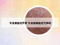 牛皮癣能吃芦笋 牛皮肤癣能吃竹笋吗