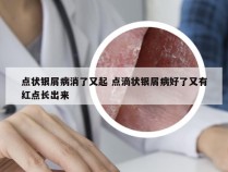 点状银屑病消了又起 点滴状银屑病好了又有红点长出来